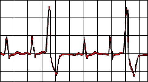 SCientific HOLter data Inter-pretation and Analysis SysTem zur Analyse von Daten eines Herzschrittmachers