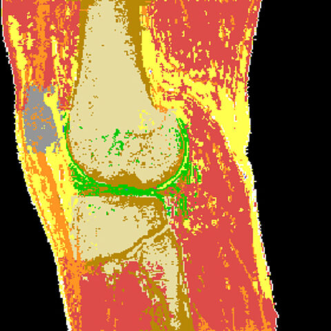 kernspintomographische 3D-Bildsequenz vom Knie